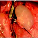 SongOtt_2013_implant-1